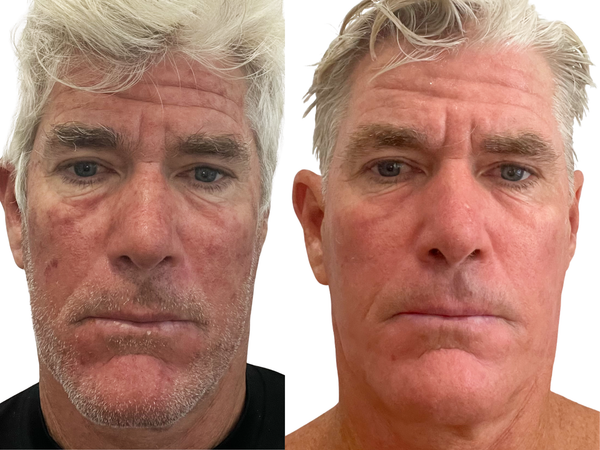 Tommy result photo